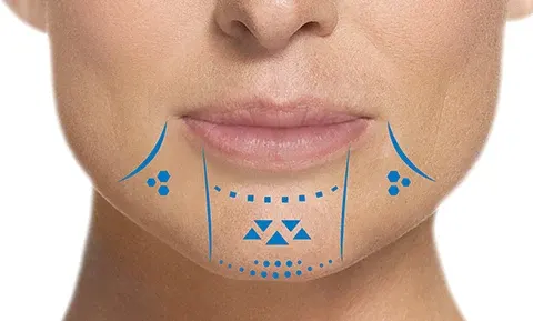 مرکز تزریق ژل چانه در کرج