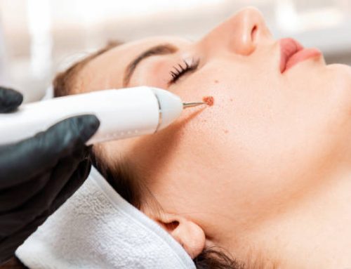برداشتن خال صورت در عظیمیه کرج – هزینه برداشتن خال صورت در عظیمیه کرج