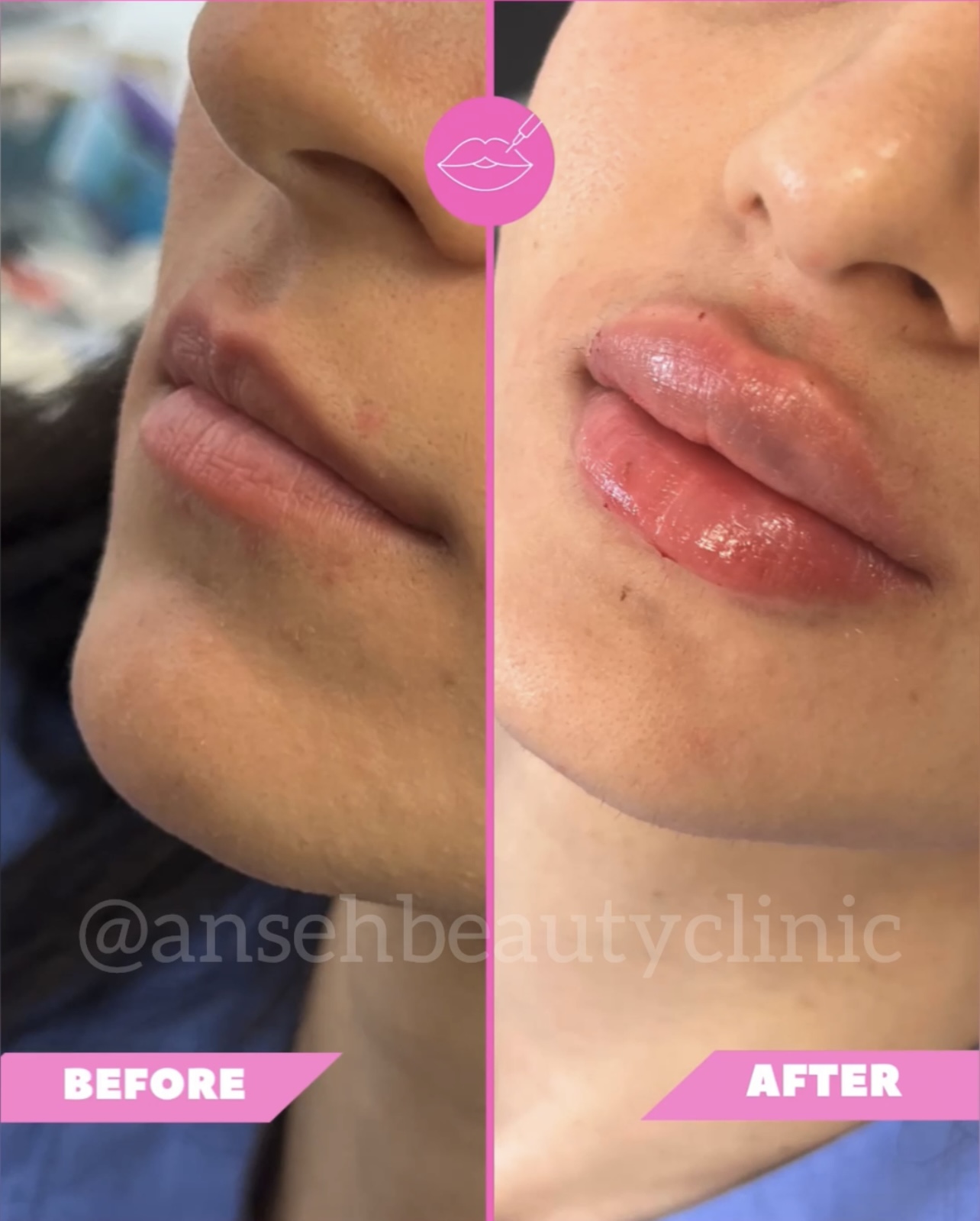 نمونه کار تزریق ژل لب در کرج