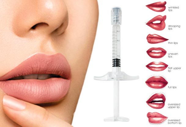 قیمت تزریق ژل لب در کرج
