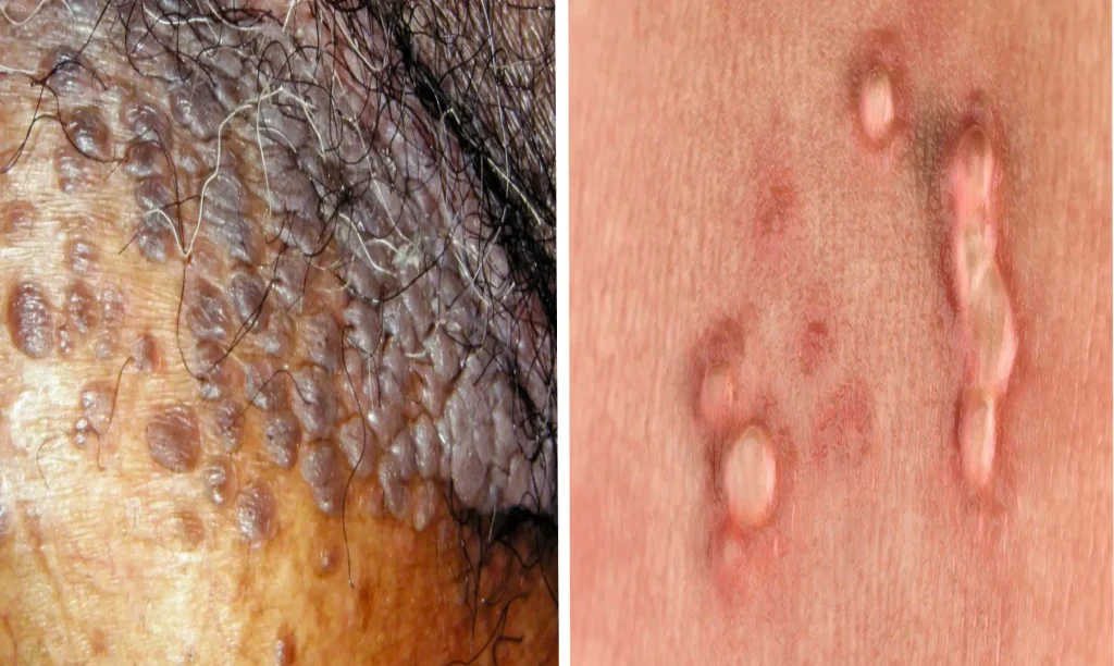 زگیل تناسلی چیست؟/ برای جلوگیری از زگیل تناسلی چکار کنیم؟