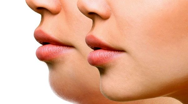 رفع غبغب در کرج/ رفع غبغب بدون جراحی