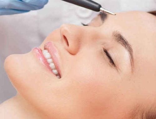 الکترولیز موهای سفید در کرج