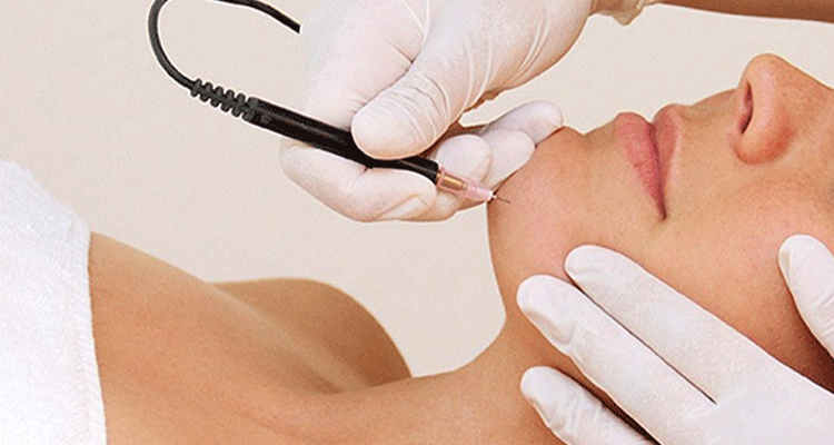 الکترولیز موهای سفید در کرج