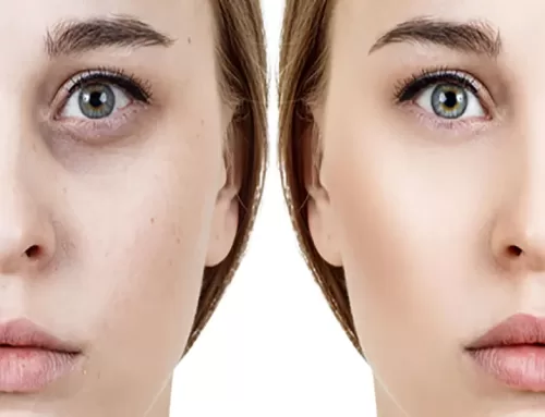 رفع گودی زیر چشم در کرج / تزریق فیلر زیر چشم با هزینه مناسب